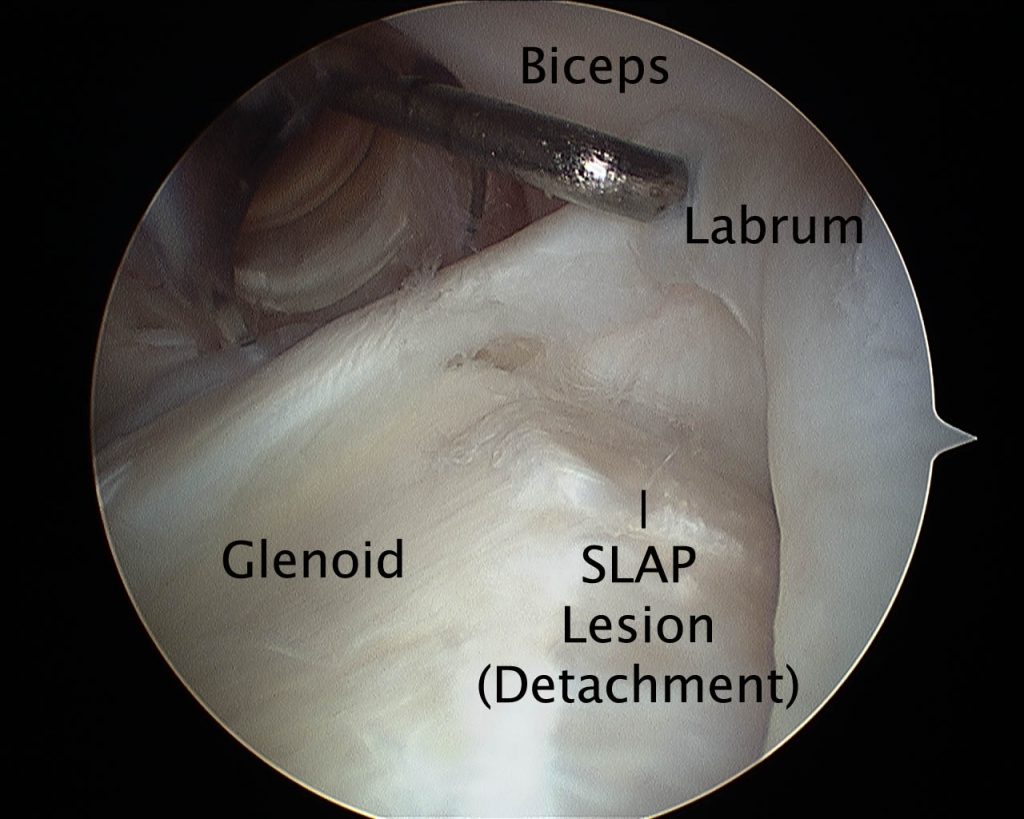 SLAP (Superior Labral Anterior Posterior) Lesion Repair | The London