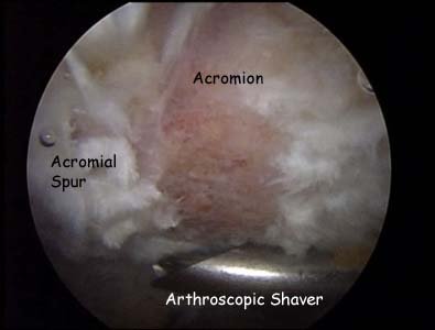 Under-surface of the acromion pre-op