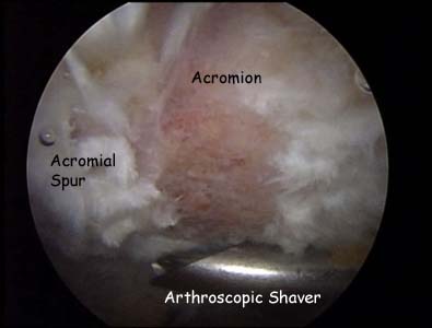 Under-surface of the acromion pre-op